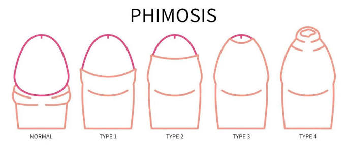 Phimosis : hygiène, sexualité et choix du préservatif